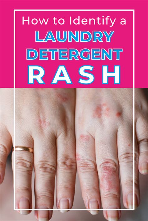 Detergent allergy rash prevention tips