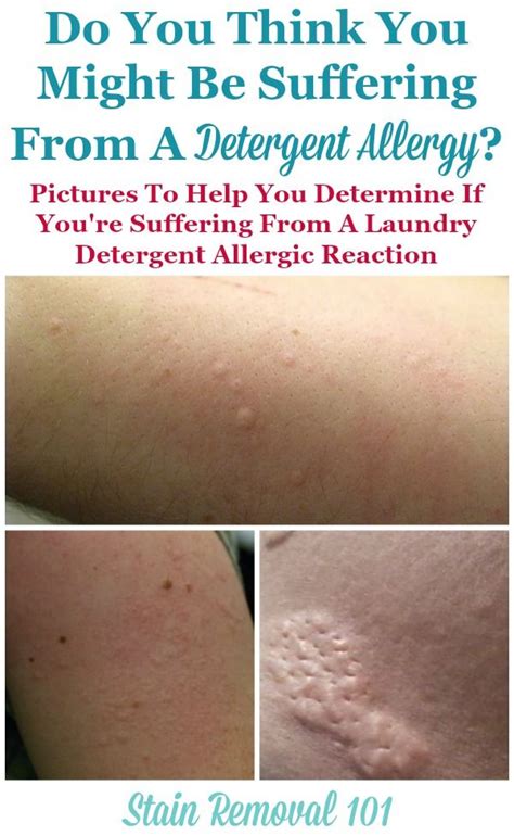 Detergent allergy rash symptoms