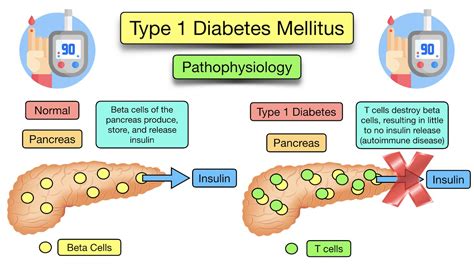 Diabetes Mellitus and Its Complications