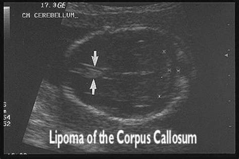 Diagnosing Lipomas in Dogs