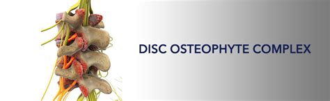 Diagnosis and Treatment of Disc Osteophyte Complex Formation