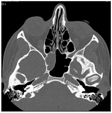 Diagnosis and Treatment of Sphenoidal Sinuses