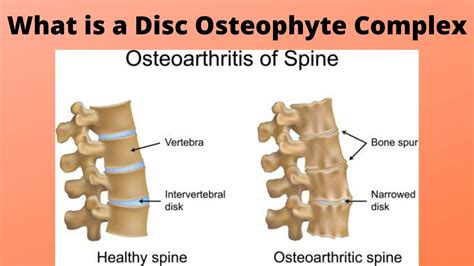 Diagnosis of Osteophyte Disk Complex