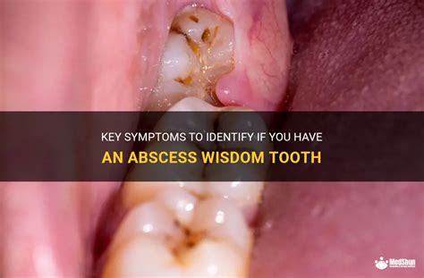 Diagnosis of wisdom tooth abscess