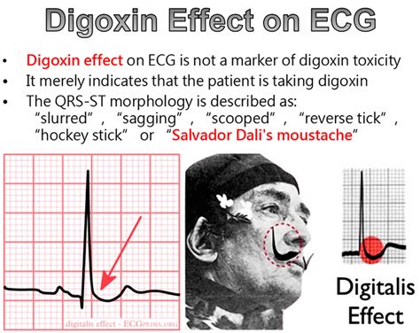 Digoxin Toxicity