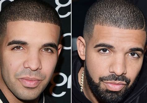 Drake nose job speculation