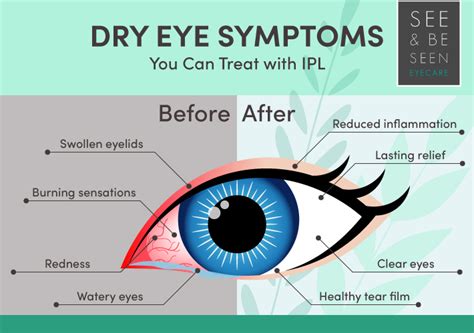 Dry eye relief