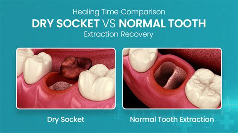 Dry socket complication