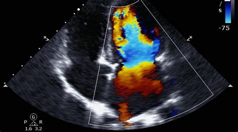 Echocardiography in Heart Failure