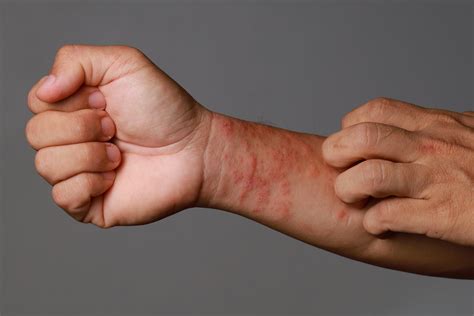 Eczema symptoms