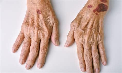 Elderly bruising causes and risk factors