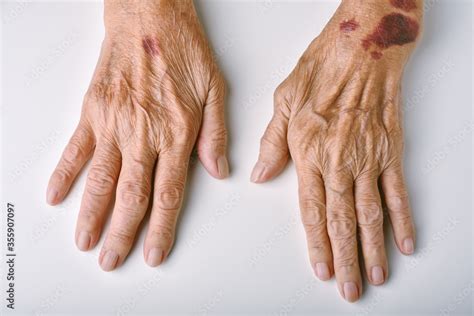 Elderly bruising image 1