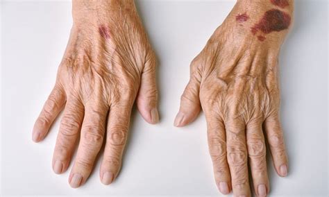 Elderly bruising image 2