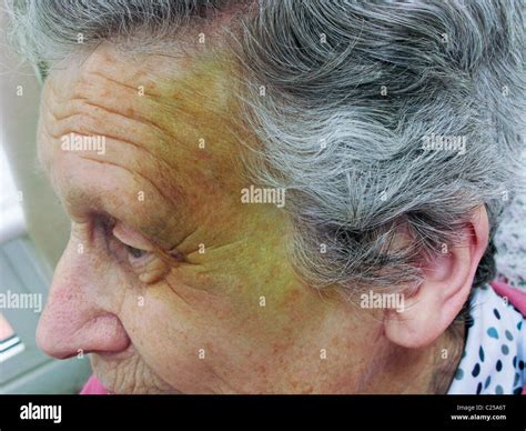 Elderly bruising image 8