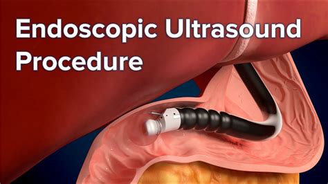 Endoscopic ultrasound image