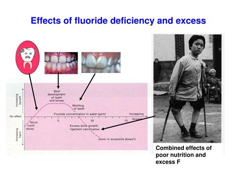 Excessive fluoride consumption risks