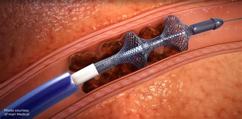 Extraction Clot Removal Procedure