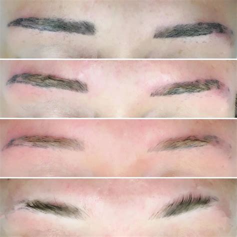 Eyebrow Tattoo Removal