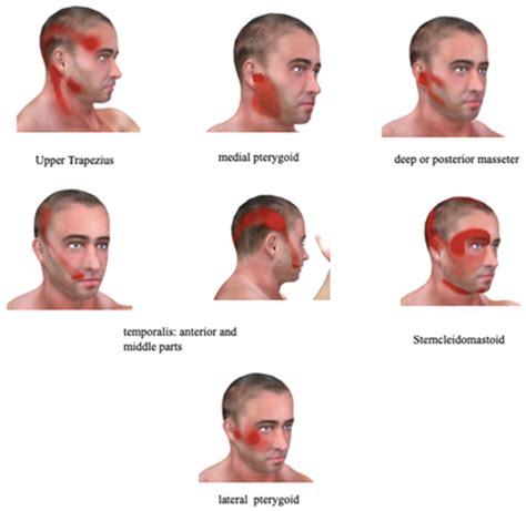 Description of Facial Pain