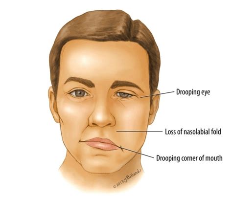 Facial Weakness in Dogs