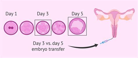 Factors Affecting Frozen Embryo Transfer Timing