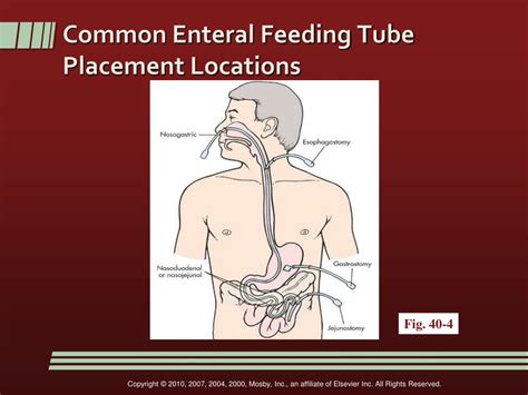 Feeding Tube Placement