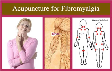 Fibromyalgia Acupuncture Therapy