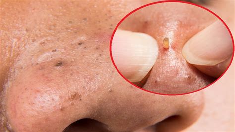 Final Thoughts on Blackhead Removal