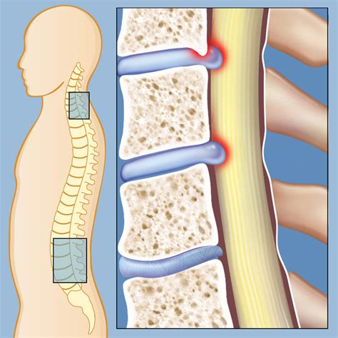 Final Thoughts on Spinal Stenosis