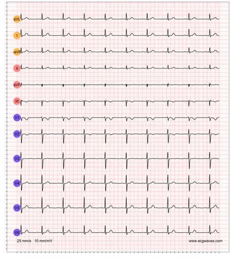 First-Degree AV Block EKG