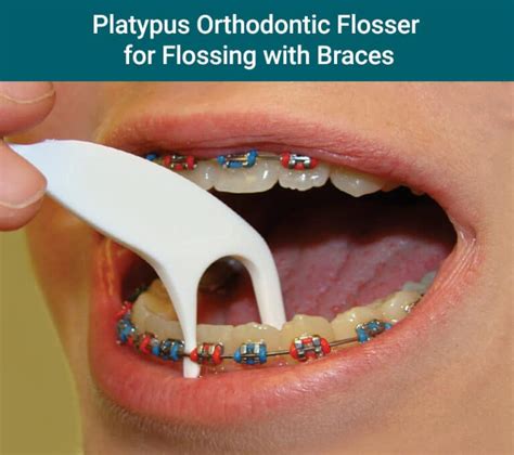 Flossing with braces