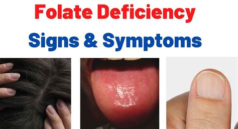 Folate Deficiency