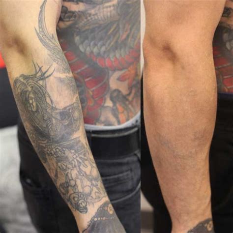 Full sleeve tattoo removal options