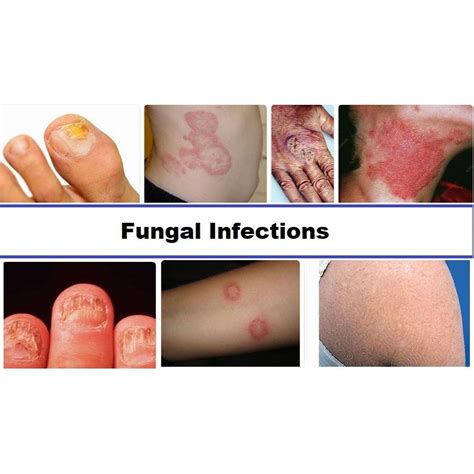 Common fungal infections