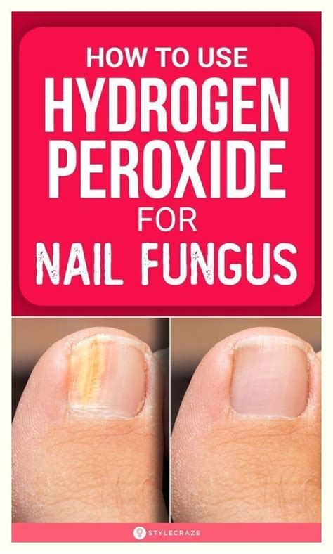 Fungus Peroxide Benefits