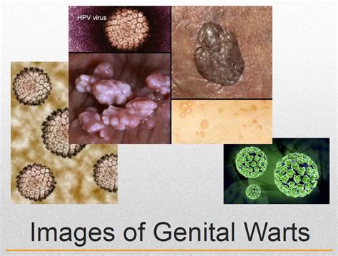 Genital warts