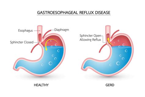 GERD System Disorder