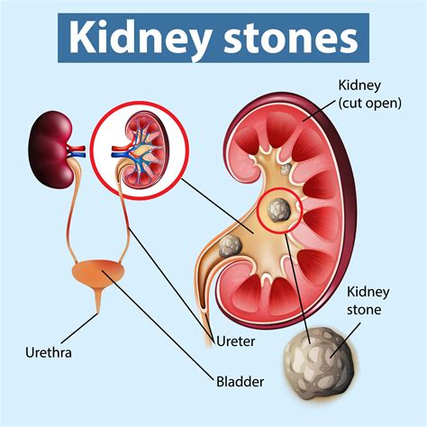 Getting Enough Sleep for Renal Calculi