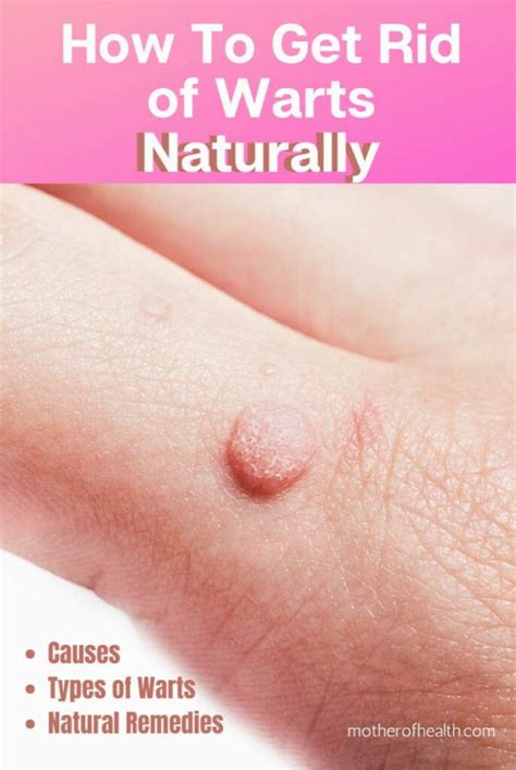 Getting rid of warts