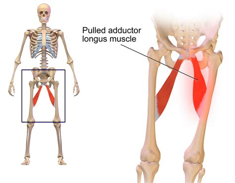 A diagram of a groin muscle injury