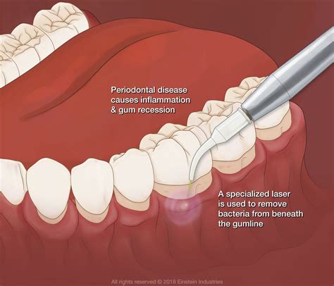 Gum Disease Treatment