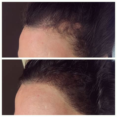 Hairline tattoo removal