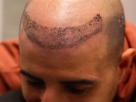 Hairline tattoo techniques