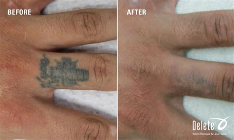 Hand tattoo removal