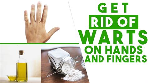 Description of Hand Wart Prevention Tips