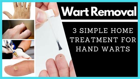 Description of Hand Wart Treatment Options