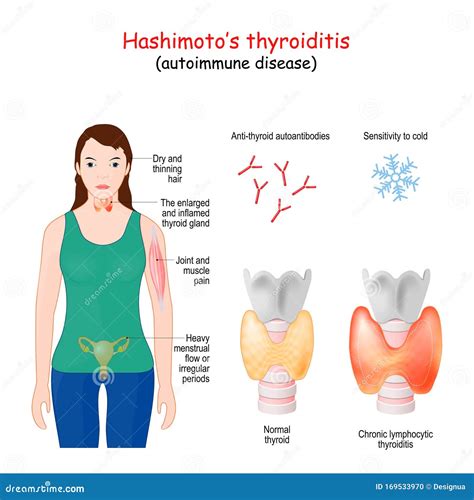 Hashimoto's thyroiditis symptoms and treatment