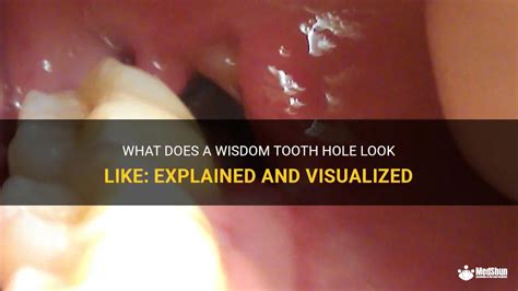 Benefits of healthy wisdom teeth holes