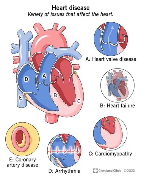 Heart Conditions Treated with Cardiac Medications