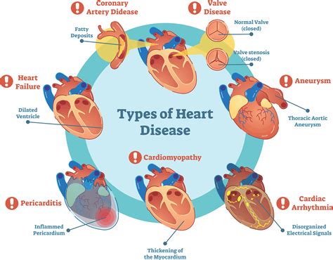 Description of Heart Disease